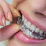 უხილავი ორთოდონტია: ყველაფერი კაპების (ელაინერების) შესახებ